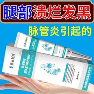 Vein i Inflammation Old Rotten i Leg Cream Lower Limb Calf Skin Blackening Rotten Limbs Rotten Limbs