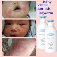 Baby Eczema Shower Gel Baby Silver Dandruff Disease Shower Gel and Shampoo Eczema Skin Itching Soap 