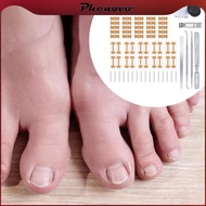 [Phenovo] Ingrown Toenail Correction Kit Efficient Ingrown Toenail Correction Patch