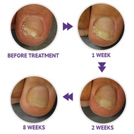 EMTRIX FUNGAL NAIL TREATMENT 10ML