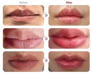 Red lip filler plump lip for dark lip Korea Made Red lips HA (1.2ml/box)