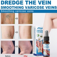 Penghilang Varises Vaskulitis Varises spray sakit bagian kaki Cream spray varises 30ML