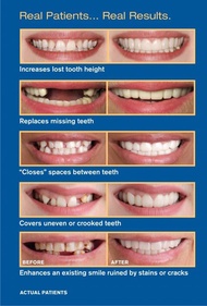 Snap on smile white smile dental