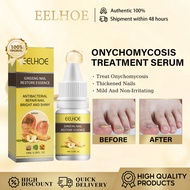 Eelhoe Ginseng Onychomycosis Treatment Serum Nail Fungal Treatment Nail Care Onychomycosis Removal N