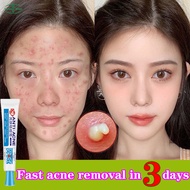 Anti-Acne Cream Acne Treatment Gel Pimple Scars Remover Skin Care Repair Comedone Pimple 30g Acne Removing Cream Antibacterial Acne Pimple Cream 祛痘膏痤疮膏淡化痘印