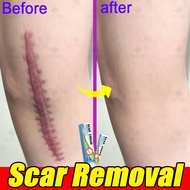 Scar Removal Cream Peklat Remover Acne Treatment Scar remover cream stretch mark Cream