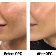 Anti aging fat burner supplement whitening pigmentation acne scar pores skin problem KenMen OPC