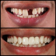 [ 2 PCS/BUNGKUS ] Super Kuat penambal gigi ompong  Gigi Palsu Penutup Ompong Depan Bawah Penambal Gi