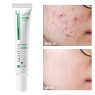Salicylic Acid Shrink Pores Face Cream Acne Treatment ลบสิวหัวดำ Whitening Oil Control Moisturizing Firm Skin Care 20G