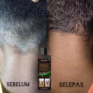 Syampu antikulat Syampu untuk kelemumur dan kulit kepala gatal Psoriasis kulit kepala Gatal kulit ke