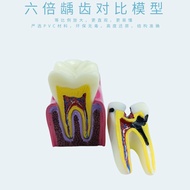 6 Times Contrast Model Dental Teaching Equipment 6 Times Contrast Model Oral Model Teaching Dental M