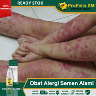 Obat Alergi Semen Alami, Obat Gatal Kulit Alergi Semen, Salep Gatal Kulit Alergi Semen, Obat Oles Un