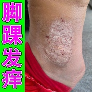 Ankle Dry Itchy Ankle Itchy Instep Itchy Stubborn Skin Dry Skin Skin Red Spots Scratchy Scratch Repa