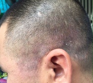 BÔi Ngoài Da Nấm Đầu đánh bay bong chóc mảng đỏ vẩy trắng gàu đóng vẩy từng mảng da đầu nấm đầu nấm