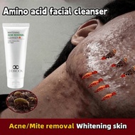 acne cleanser黑頭粉刺祛痘膏美白洗面奶100g Whitening Acne Removal Cleanser Face Care Wash Anti-acnes Brighten Ski