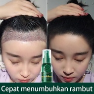 (100% Asli)Penumbuh rambut botak serum penumbuh rambut penumbuh rambut