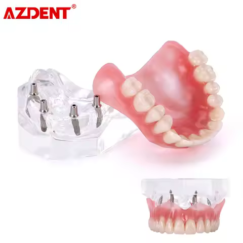 AZDENT Dental Teeth Model Demo Overdenture Restoration With Implants upper/Lower Dentist Student Lea