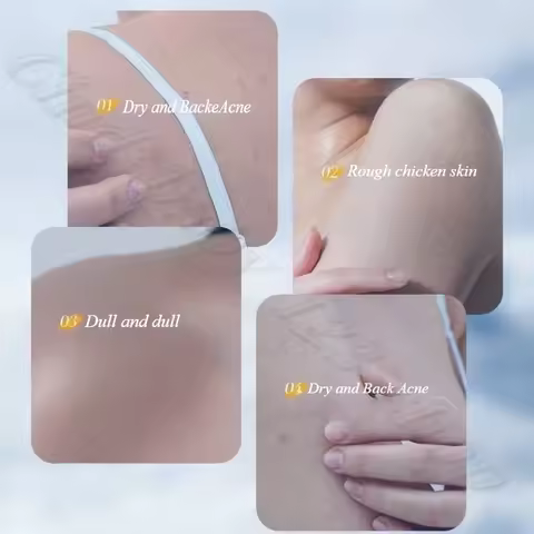 OHBT Nicotinamide Fruit Acid Brightening Cream Desalination Pigment Removal Chicken Skin Improvement