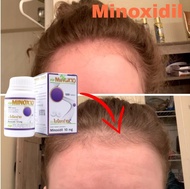 Minox10 Minoxidil 100tabs