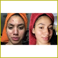 ➕◬ ╰ ⛅ Dr. S. Wong's Bioderm Ointment and Sulfur Soap with moisturizer Anti Acne Remove pimple