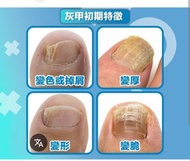 灰甲的演變 傳染力強 小心受感染 成分 功效 與 羅霉樂一樣 詳情請pm查詢