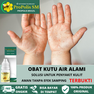 Obat Kutu Air Buat Bayi, Obat Oles Kulit Gatal Bayi 12 Bulan, Pembersih Kuman Air, Sela Kaki Basah B