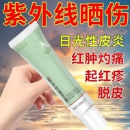过敏专用膏太阳晒伤皮肤发痒日光皮炎晒后修复脱皮6.29 Special cream for allergies, itchy skin caused by sunburn, sun dermatiti