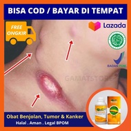Obat Tumor Di Leher Colli - Obat Penghancur Benjolan Di Leher - Herbal Untuk Tumor Ganas / Jinak Di