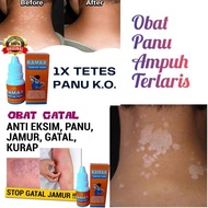 OBAT PANU PALING AMPUH ASLI OBAT PANU KADAS KURAP EKSIM ORIGINAL /Obat Panu Paling Ampuh Asli Kamax 