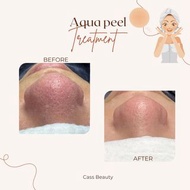 Aqua peel Treatment