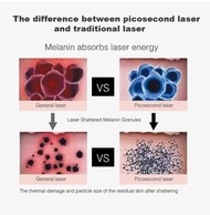 4 Probe Penghapusan Tato Laser Penghapusan Bekas Luka Pigmen Benar