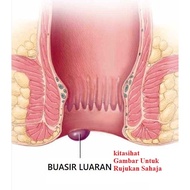 masalah Buasir luaran Buasir dalaman#bentuk PIL⭐LAINindividuLAINkesan#ubat tradisionl