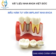 Implant Consulting Jaw Model, Dental Consulting Jaw