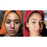 ♞,♘Dr. S. Wong's Bioderm Ointment and Sulfur Soap with moisturizer Anti Acne Remove pimple