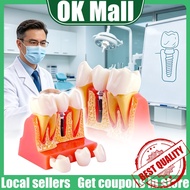 【READY STOCK】Implant Analysis Crown Bridge/Dental Implant Model Mold Teaching Oral Dentures/Demonstr