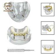 Dental implant model with restoration 4 implant nail ball cap combined with half-mouth comprehensive