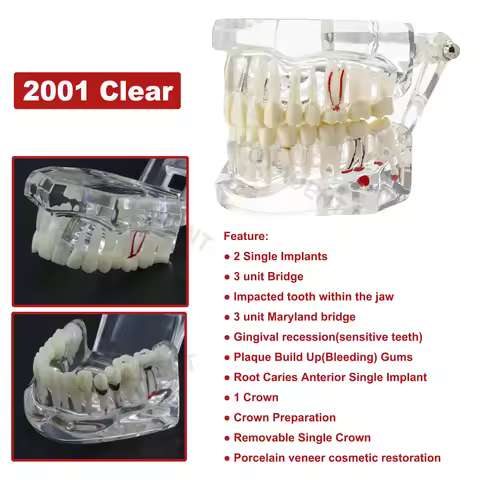 Dental Model Teeth Implant Model 3 Unit Bridge Restoration Resin For Doctor Patient Communication De