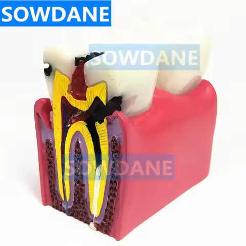 1pc Dental Anatomy Education Teeth Model 6 Times Caries Comparation Study Models For Dentist Studyin