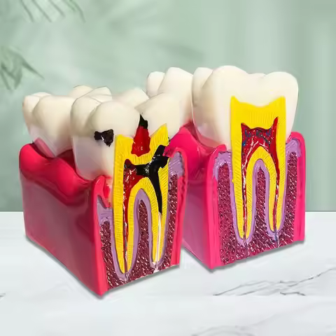 Dentistry, Oral 6x Caries Comparison Model Caries Evolution Process Doctor-patient Teaching Communic