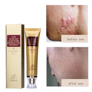 LANBENA Acne Scar Remove Serum Acne Treatment Remover Stretch Marks Anti Acne 3PCS+Acne Scar Removal