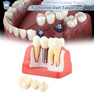 Dental Implant Model Tooth Model Implant Crown Bridge Educational Tooth Model 4 Magnification