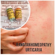 URTICARIA - HOMEOPATHY TREATMENT