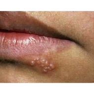 ubat sapu herpes ..coldsore