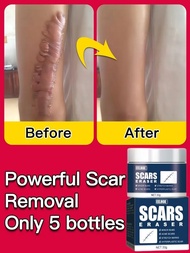 ❣  New Rapid Scar Removal Cream Effective Treatment Stretch Marks Burns Lighten Acne Spots Section Scars Whiten Skin Care Products