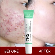 Acne Scar Treatment Cream Acne Scar Removal Cream Acne Pimple Removal Skin Repair Fragrance Free Par