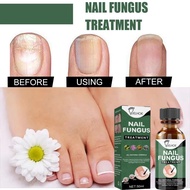 Nail Fungus Treatment Oil Soften Renew Damaged Broken Nails Fungal Inhibition Care Solution Effectiv
