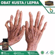 Obat Kusta - Obat Lepra - Obat Kusta Kering - Obat Kusta Basah - Obat Kusta Lepra - Obat Lepra Kusta