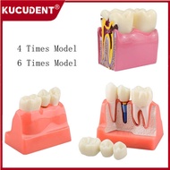 Dental Teeth Implant Model 4/6 Times Caries Comparsion Denture Models ysis Crown Bridge s