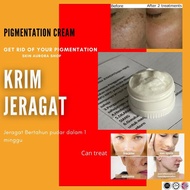 Krim Jeragat 5gram And 10gram Pigmentation Cream Ubat Jeragat