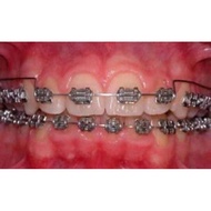 Door Teeth Group Quicksand - Upper Jaw & Lower Jaw